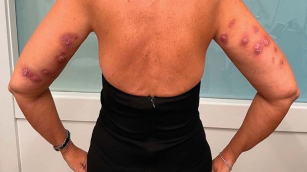 The FDA warns that fat dissolvers are unapproved and may cause significant reactions. A woman who received injections with Lipodissolve, a drug that is not FDA approved, reported a severe reaction. (Kaur, H, C Reyes-Barron, WH Sipprell, A Cameron, T Louie, PR Tsai, and G Scott via FDA)