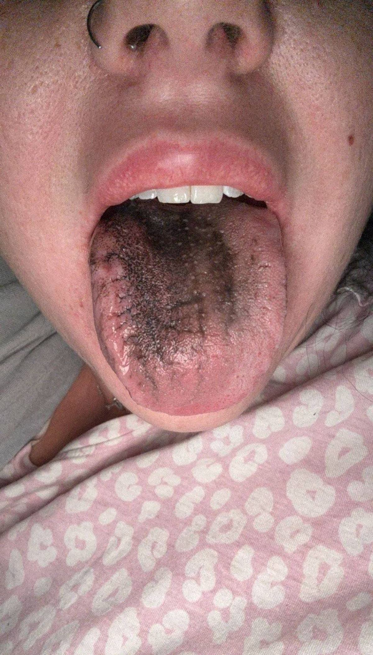 Sarah-Jayne's black tongue after taking Wegovy
