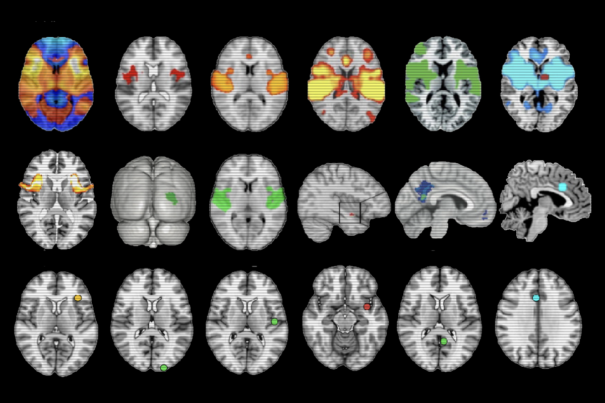 ‘Overdue’ debate unfurls over neuroimaging method