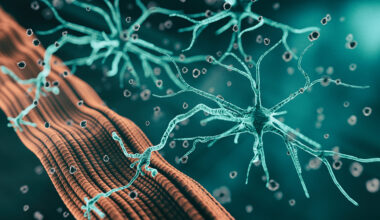 Lipid signatures for a rare neurological disorder