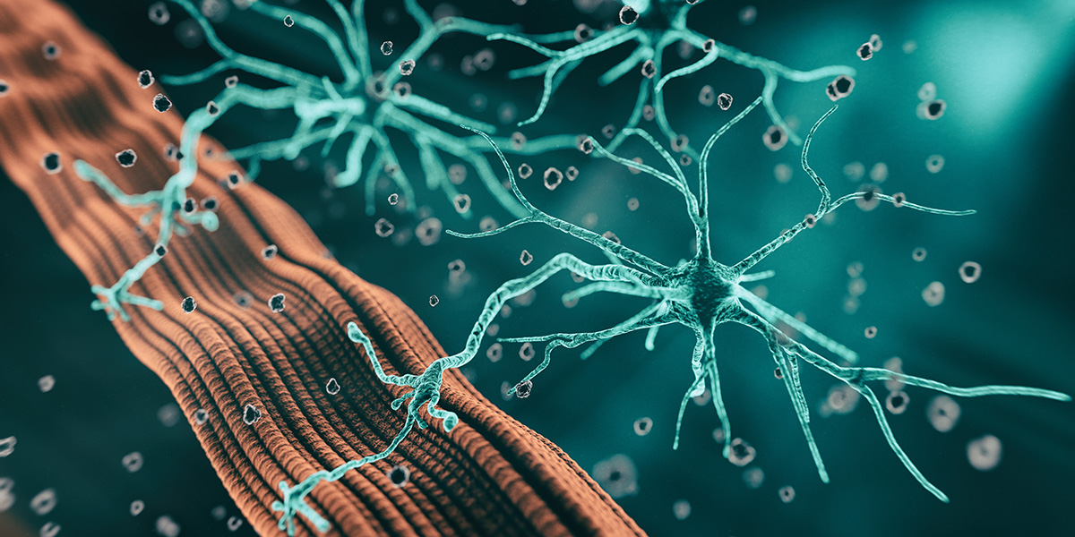 Lipid signatures for a rare neurological disorder