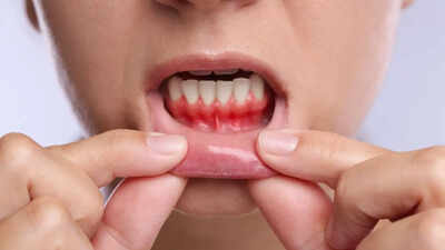 Bleeding gums may signal more than oral disease: How gum health is linked to heart risk and inflammation