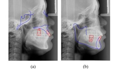 Reliability assessment of the non-rigid registration for central incisors movement evaluation based on CBCT registration