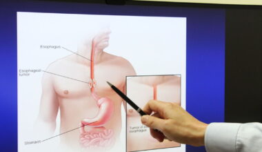 Hot drinks and heartburn could be raising your cancer risk