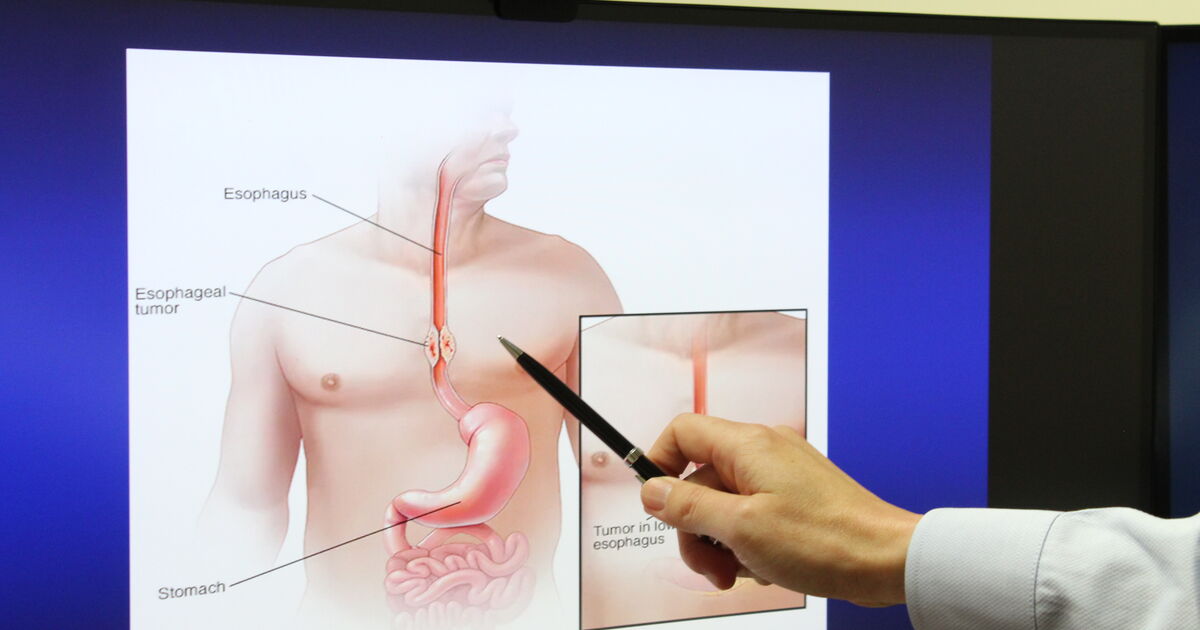 Hot drinks and heartburn could be raising your cancer risk