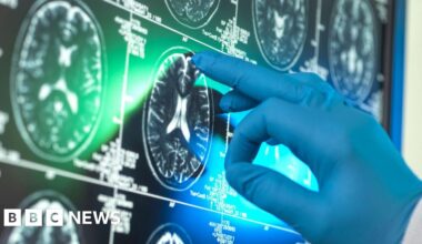 'Breakthrough' Alzheimer's drugs unlikely to benefit patients, report suggests - BBC