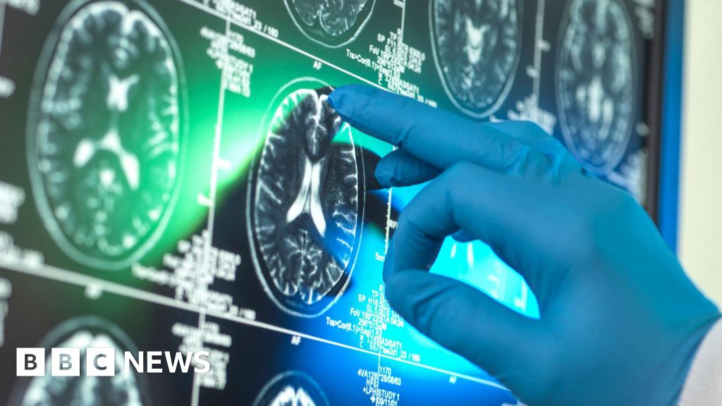 'Breakthrough' Alzheimer's drugs unlikely to benefit patients, report suggests - BBC