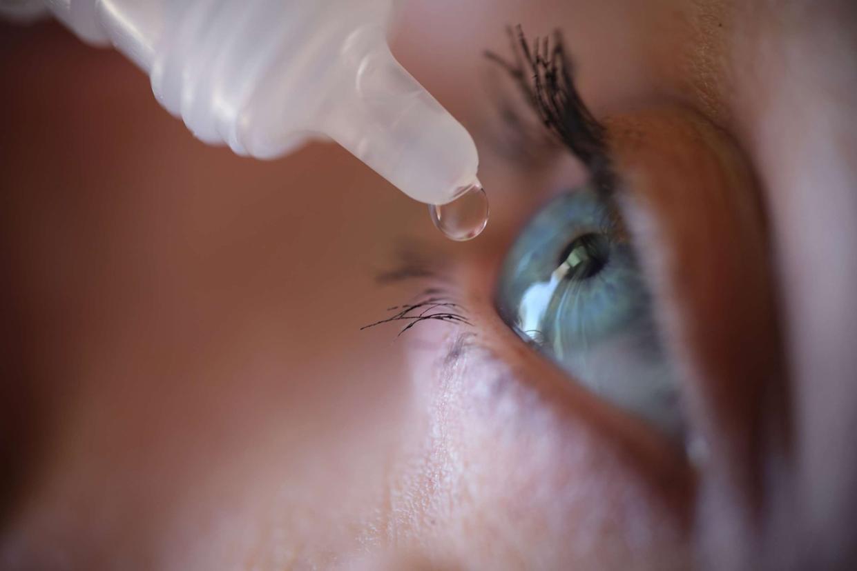 STOCK PHOTO/Getty Images - PHOTO: Stock photo of a woman applying eye drops to her eye.