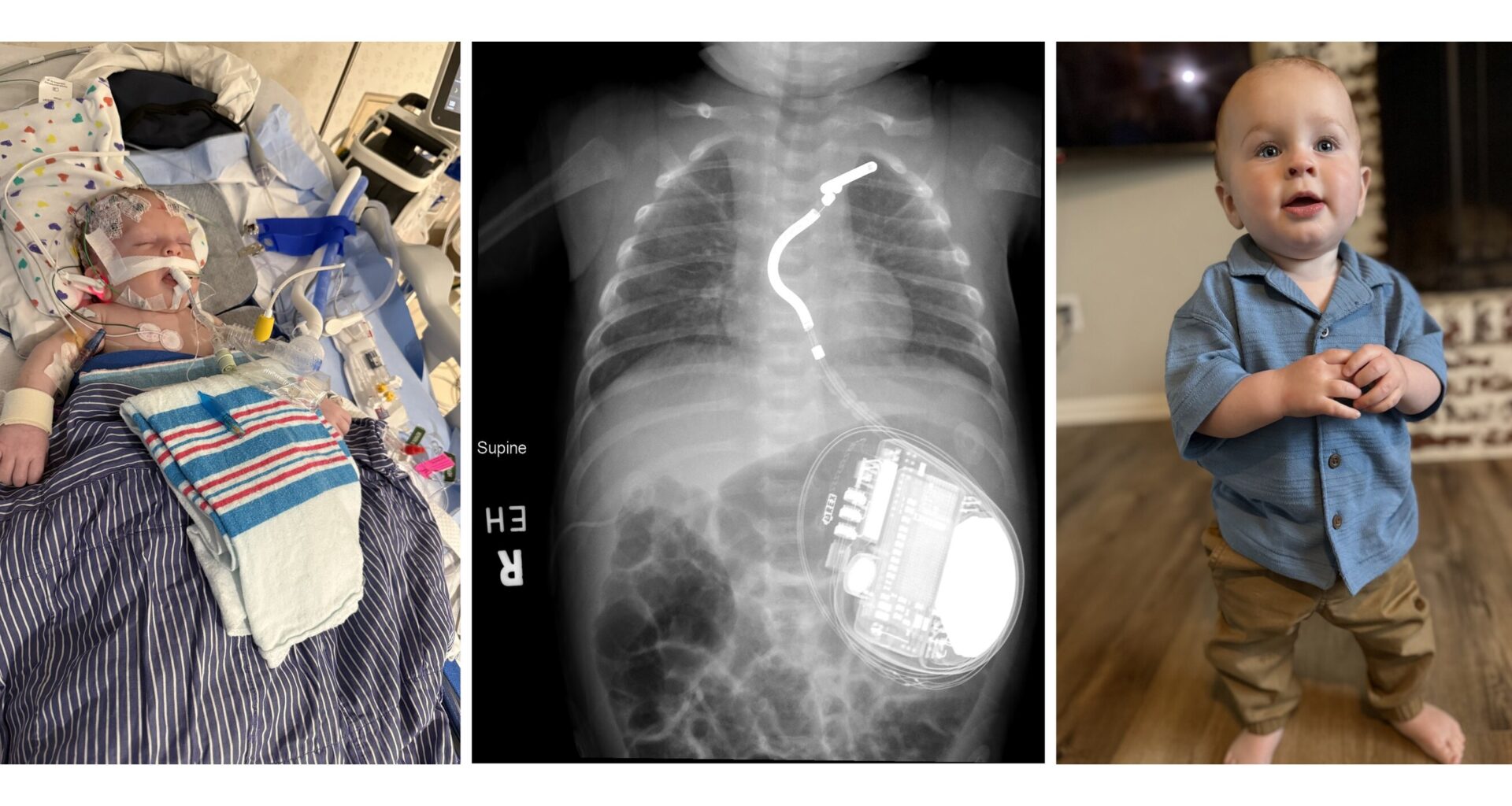 Speed, Expertise and Advanced Technology Combine to Save an Infant's Heart