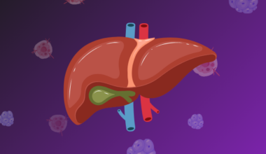 Ablative therapy improves overall survival for 'supermassive' bile duct tumors patients