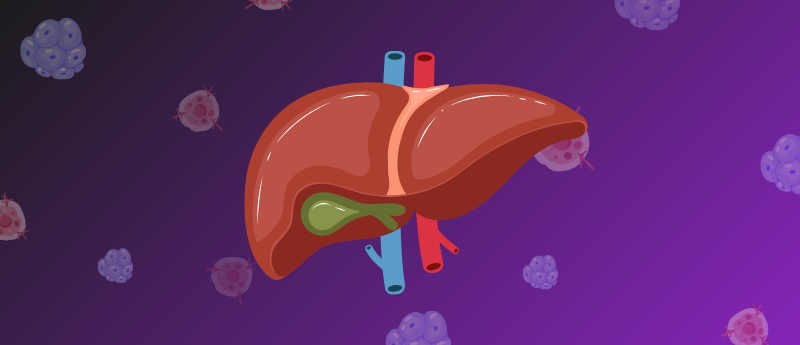 Ablative therapy improves overall survival for 'supermassive' bile duct tumors patients