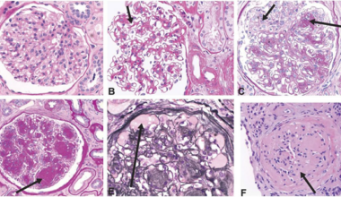 Histology images showing structural changes related to diabetic glomerulopathy. <strong>A</strong> Normal glomerulus. <strong>B</strong> Diffuse mesangial expansion with mesangial cell proliferation. <strong>C</strong> Prominent mesangial expansion with early nodularity and mesangiolysis. <strong>D</strong> Accumulation of mesangial matrix forming Kimmelstiel-Wilson nodules. <strong>E</strong> Dilation of capillaries forming microaneurysms, with subintimal hyaline (plasmatic insudation). <strong>F</strong> Obsolescent glomerulus. <strong>A</strong>–<strong>D</strong> and <strong>F</strong> were stained with period acid-Schiff stain. <strong>E</strong> was stained with Jones stain. Original magnification ×400. Reprinted with permission from American Society of Nephrology