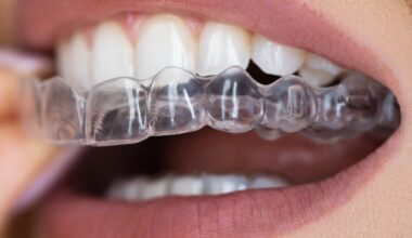 Study: The Changes of Microbiome Attached on Clear Aligners after Drinking Coca-Cola. Image Credit: Andrey_Popov / Shutterstock