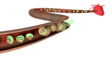 Elevated Lp(a) levels associated with residual cardiovascular risk