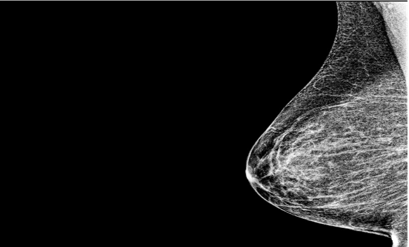 CEM Matches MRI in Breast Cancer Imaging Performance - EMJ