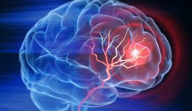 Low Birthweight Increases Risk of Early Stroke