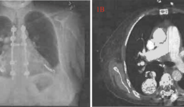 Severe Transfusion-Dependent Anemia in Hereditary Hemorrhagic Telangiectasia: A Critical Case of Gastrointestinal Bleeding and Pulmonary Arteriovenous Malformation