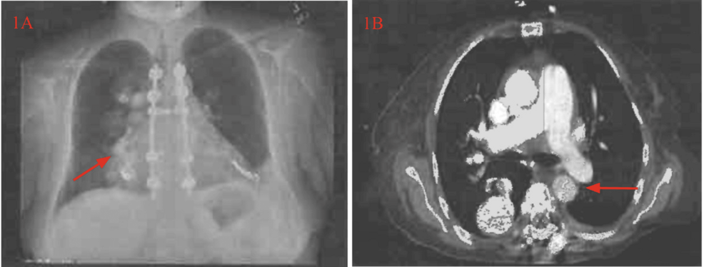 Severe Transfusion-Dependent Anemia in Hereditary Hemorrhagic Telangiectasia: A Critical Case of Gastrointestinal Bleeding and Pulmonary Arteriovenous Malformation