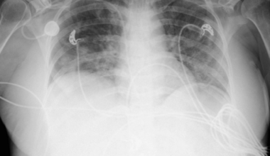 Reversible Sepsis-Induced Myocardial Dysfunction in Term Pregnancy: A Case Report of a Rare Medical Condition