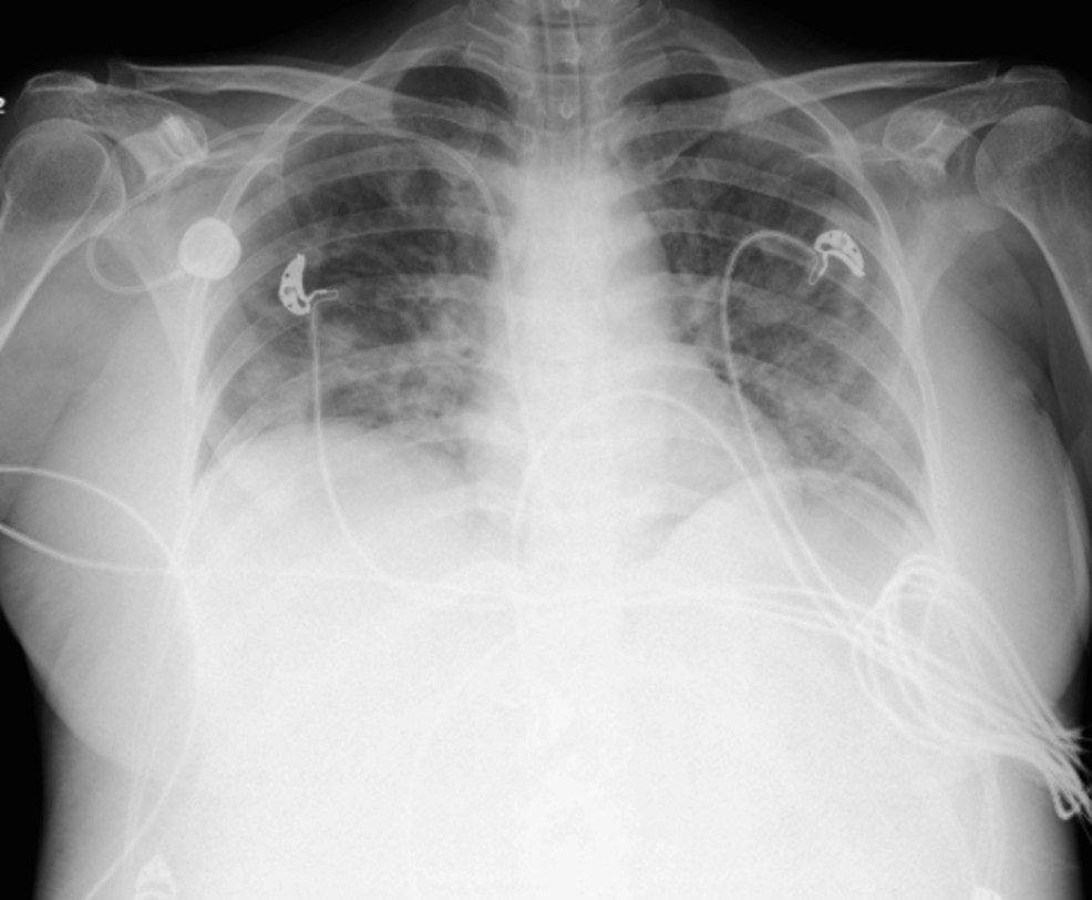 Reversible Sepsis-Induced Myocardial Dysfunction in Term Pregnancy: A Case Report of a Rare Medical Condition