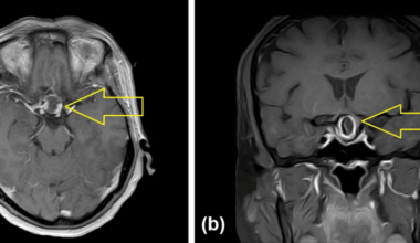 The Great Pretender in the Sella: A Rare Doughnut-Shaped Partially Thrombosed Internal Carotid Artery Aneurysm Mimicking Pituitary Macroadenoma