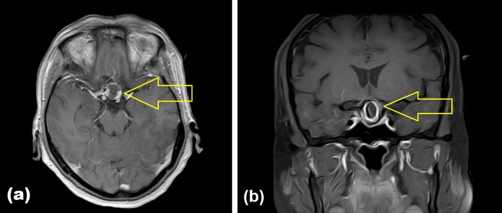 The Great Pretender in the Sella: A Rare Doughnut-Shaped Partially Thrombosed Internal Carotid Artery Aneurysm Mimicking Pituitary Macroadenoma