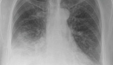 A Rare Case of Stevens-Johnson Syndrome Secondary to Levofloxacin Administration: Presentation and Management
