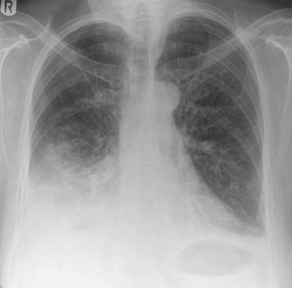 A Rare Case of Stevens-Johnson Syndrome Secondary to Levofloxacin Administration: Presentation and Management
