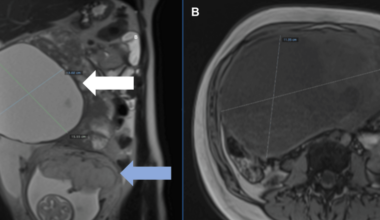 Epithelial Ovarian Cancer With Cardiac Metastases in Pregnancy: A Case Report