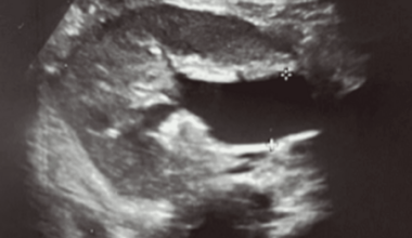 Partial Distal Ureteral Obstruction After Pediatric Kidney Transplantation: A Diagnostic Challenge