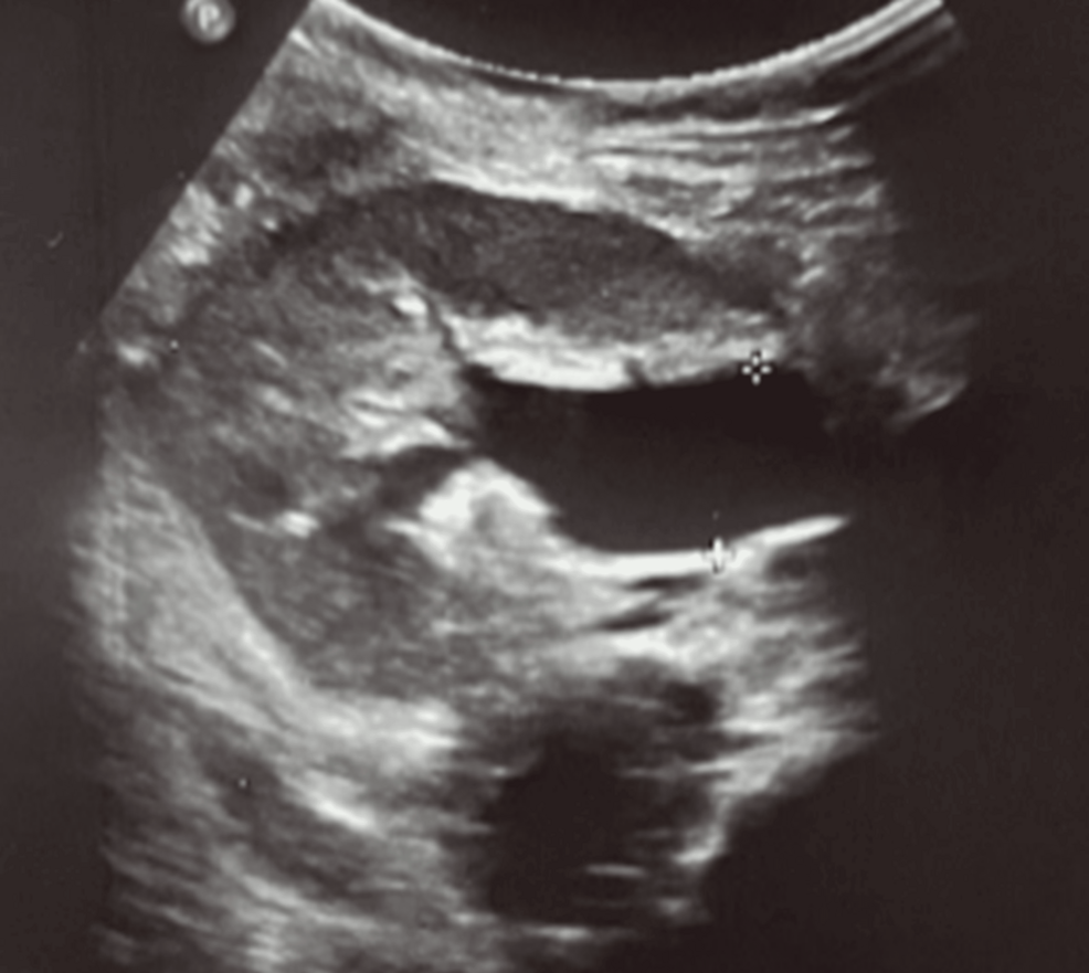 Partial Distal Ureteral Obstruction After Pediatric Kidney Transplantation: A Diagnostic Challenge