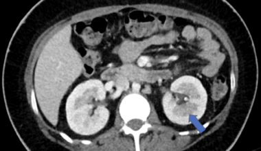 Navigating a Delicate Balance: Antibiotic Allergy in the Setting of Renal Infection and Diabetic Ketoacidosis