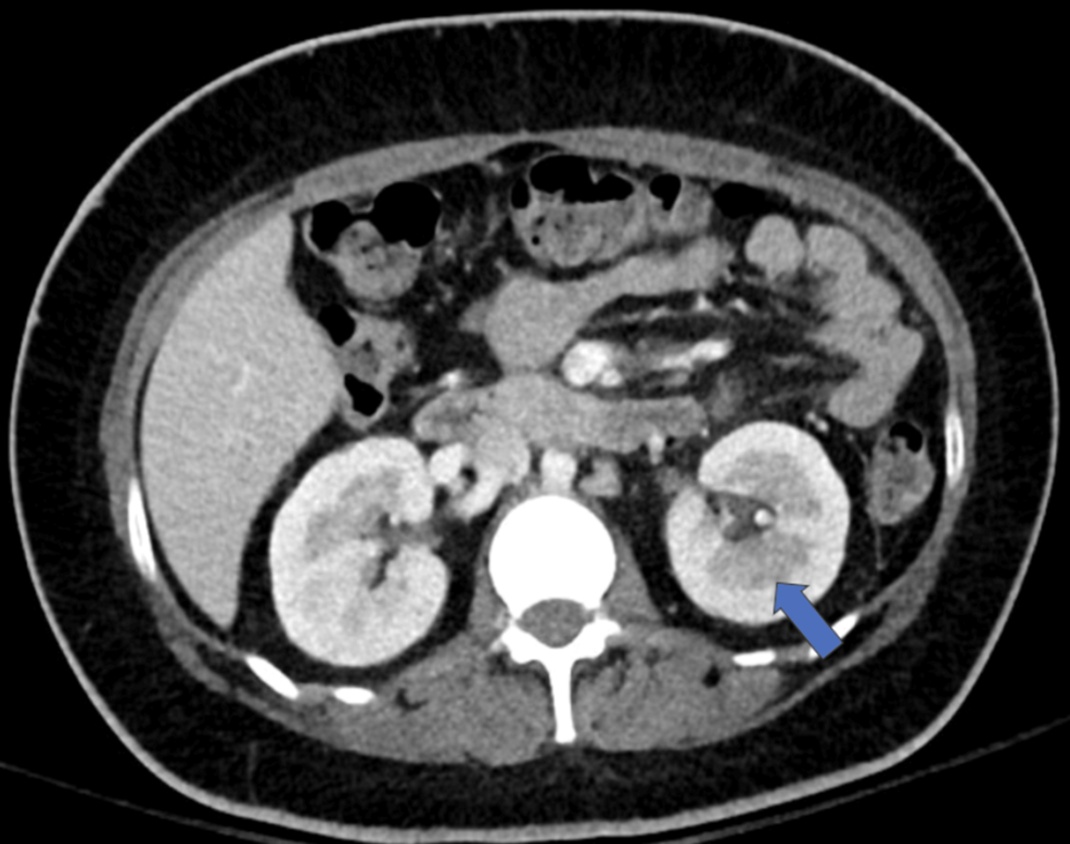 Navigating a Delicate Balance: Antibiotic Allergy in the Setting of Renal Infection and Diabetic Ketoacidosis