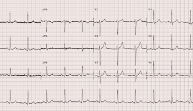 Intraoperative Cardiac Arrest Triggered by Carbon Dioxide Insufflation During Laparoscopic Surgery: A Case Report