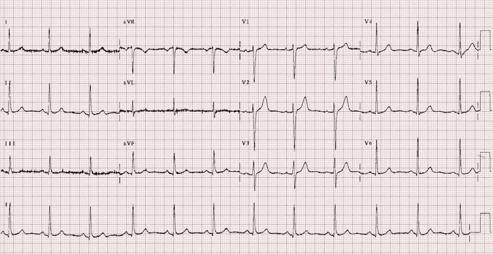 Intraoperative Cardiac Arrest Triggered by Carbon Dioxide Insufflation During Laparoscopic Surgery: A Case Report