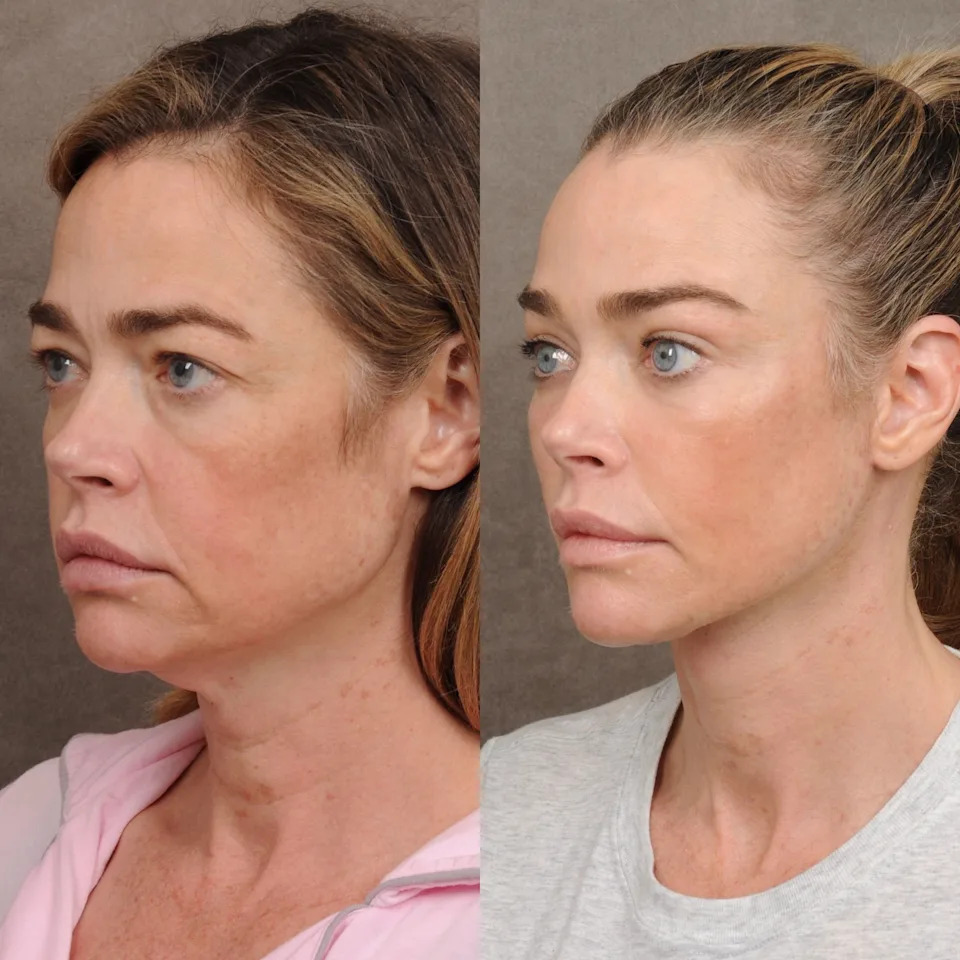Denise Richards photographed from all angles before and after her surgeries.