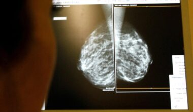 Hospitals consider replacing some radiologists with AI