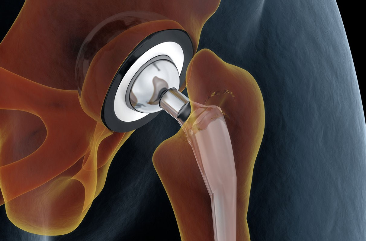 An illustration of a hip replacement is shown.