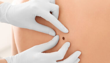 AI Shows Dermatologist-Level Accuracy in Melanoma Diagnosis but Needs Validation