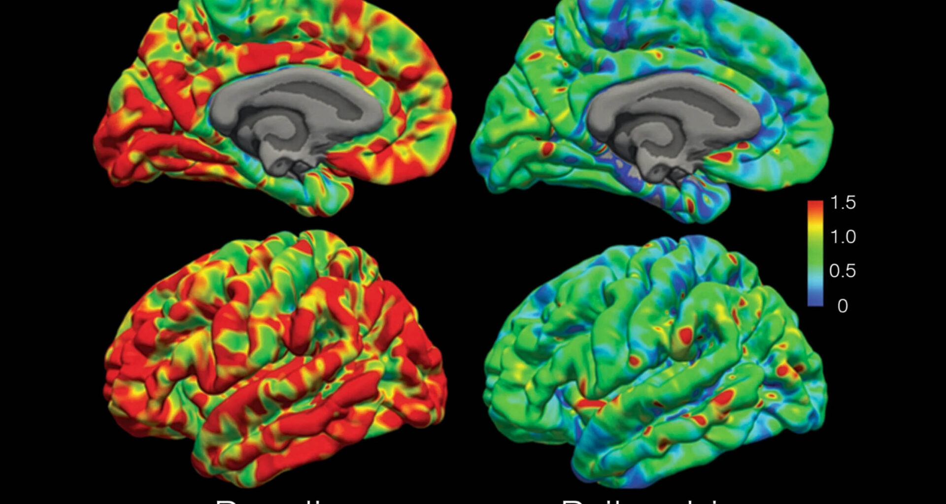 Different psychedelics create very similar brain wave patterns