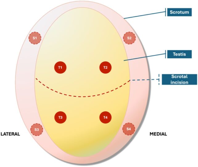 Man With Infertility Regains Sperm