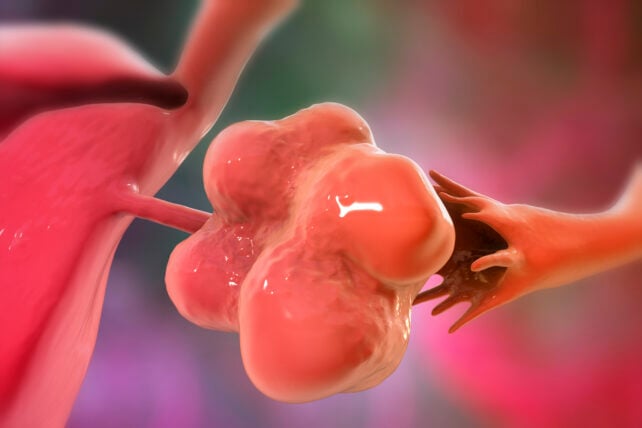 PMOS Ovary