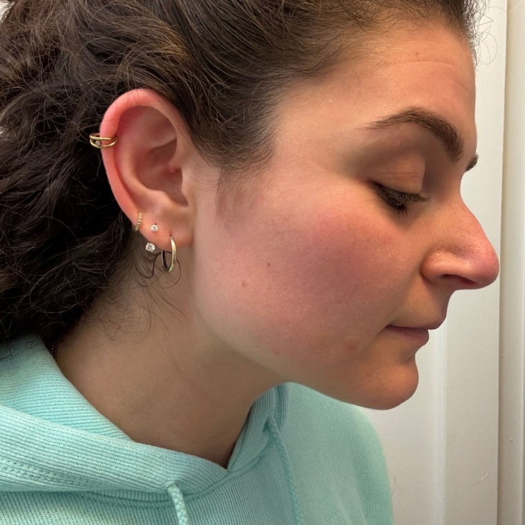 A woman wearing Hero Cosmetics’ The Original Mighty Patch (right) and the Invisible+ Mighty Patch (left).