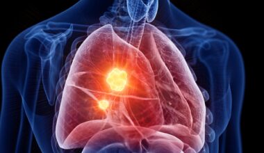 Lung Cancer Tumor Disease Anatomy Close