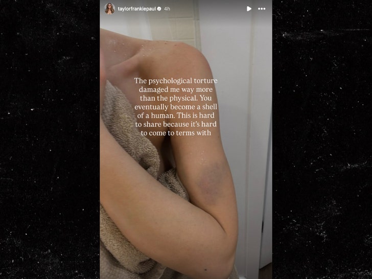 sub-frankie-taylor-paul-arm-bruise-ig-1