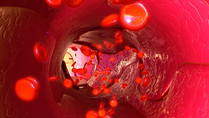 Promising Signal Only ctDNA in Early Breast Cancer Not Yet Ready for Clinical Use