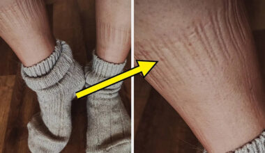 Here's What It Means If Your Socks Leave Marks On Your Legs, And When To Be Concerned