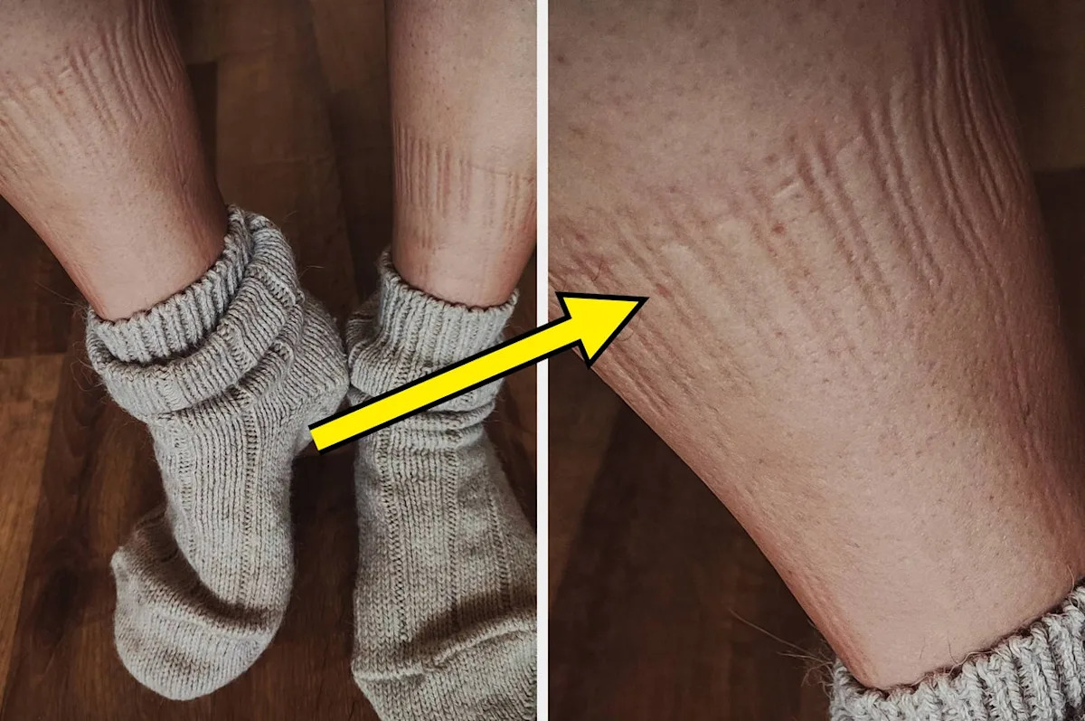 Here's What It Means If Your Socks Leave Marks On Your Legs, And When To Be Concerned