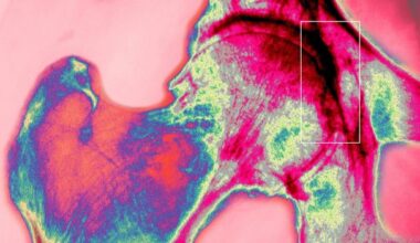 Bone is a wonder material. Scientists are defying physics to mimic it for longer-lasting hip replacements