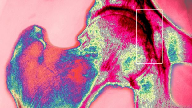 Bone is a wonder material. Scientists are defying physics to mimic it for longer-lasting hip replacements